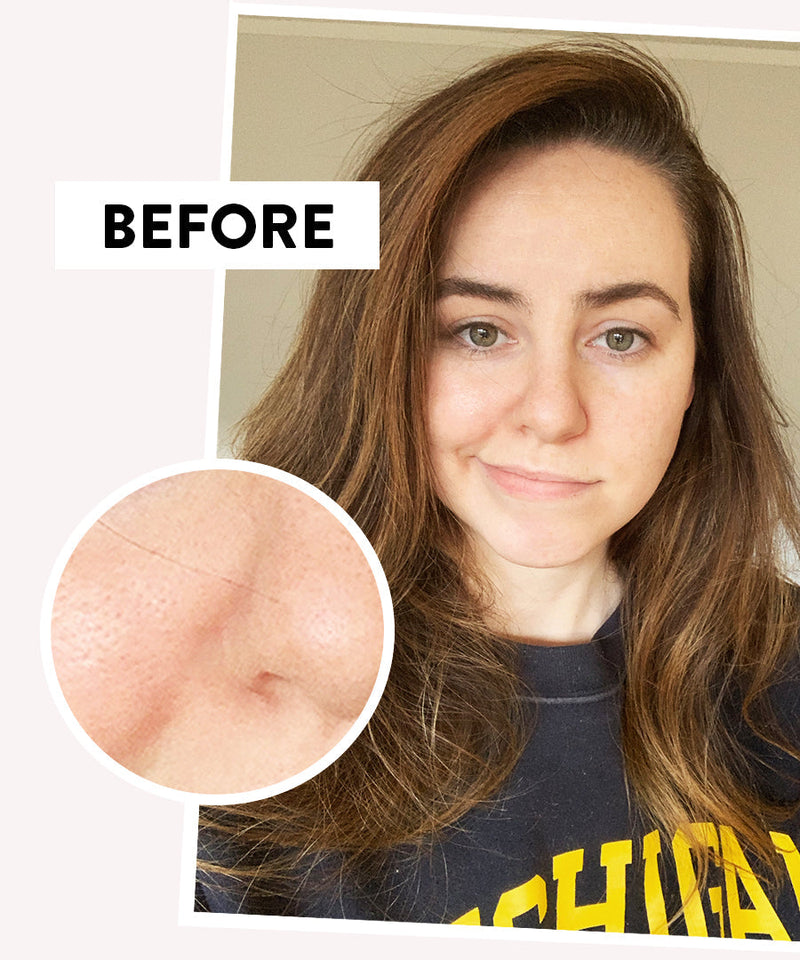Blackhead Remover “Comes with a Warranty”